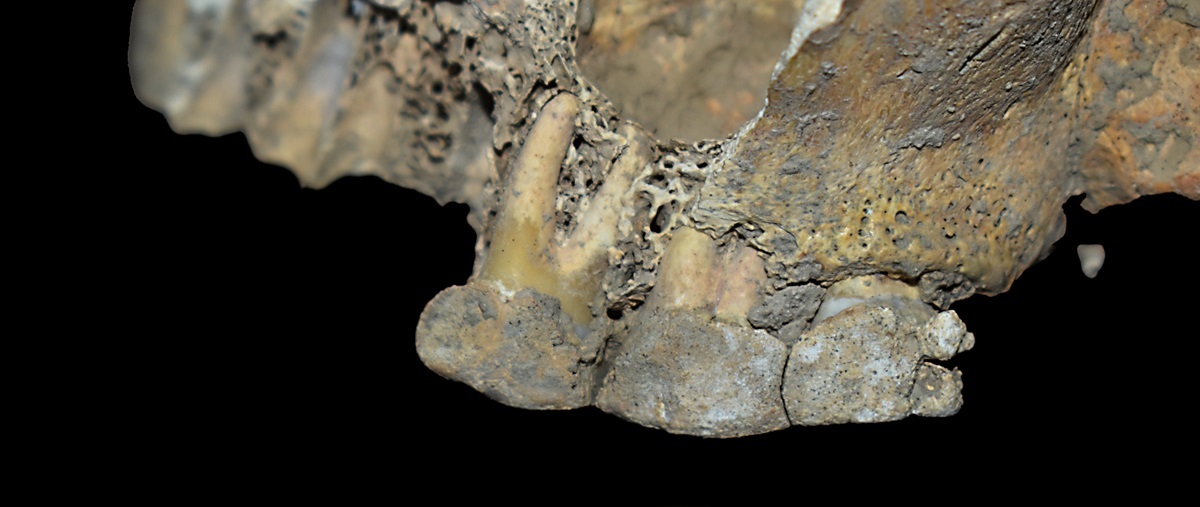 Starke Ablagerungen an Zahnstein auf der Außenseite der oberen Backenzähne.