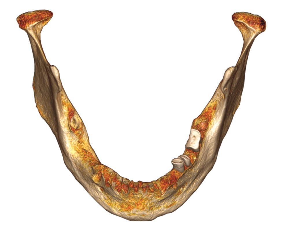 Dreidimensionale Rekonstruktion des Unterkiefers einer Person in fortgeschrittenem Alter (senil). 