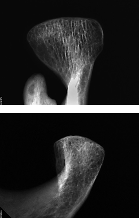 Die Röntgenbilder zeigen das von Arthrose betroffene linke Unterkiefergelenk.