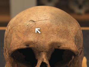 Wikingerschädel mit Spuren von brutaler, stumpfer Gewalt (Pfeil)