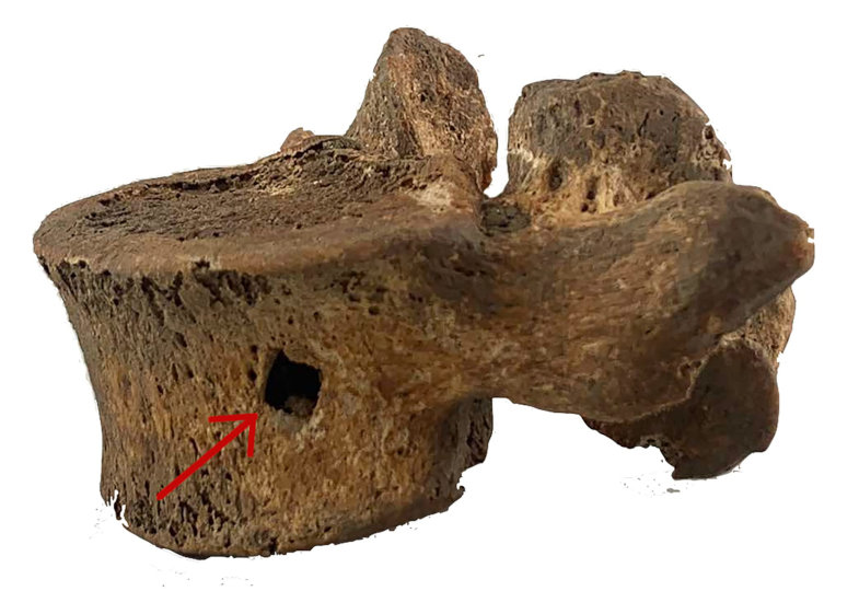Römischer Lendenwirbel mit Einschuss durch Eisenbolzen