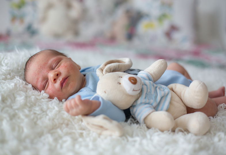 Hautausschläge bei Kleinkindern: unschön, aber meist harmlos