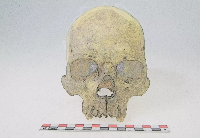 Grafische Darstellung eine menschlichen, 4000 Jahre alten Schädels, aus dem das Genom des Mycobacterium lepromatosis gewonnen wurde