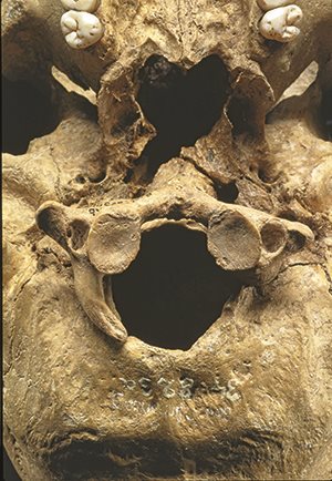 Schädelbasis der Frau mit unvollständig ausgebildetem erstem Halswirbel. Inzwischen konnte der ebenfalls anormale zweite Halswirbel geborgen werden.