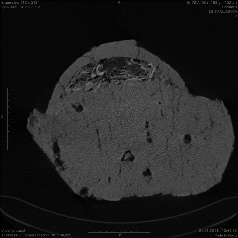 Die Kombination der Methoden zeigt, dass der Leichenbrand in einem organischen Behälter gebündelt am Urnenboden deponiert wurde.