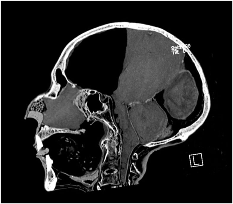 Zweidimensionales CT-Bild des Kopfes von Ramses II. Die Einbalsamierern legten einen kleinen Tierknochen und schwarze Pfeffersamen in die Nasenhöhle, um die Form der Nase zu erhalten