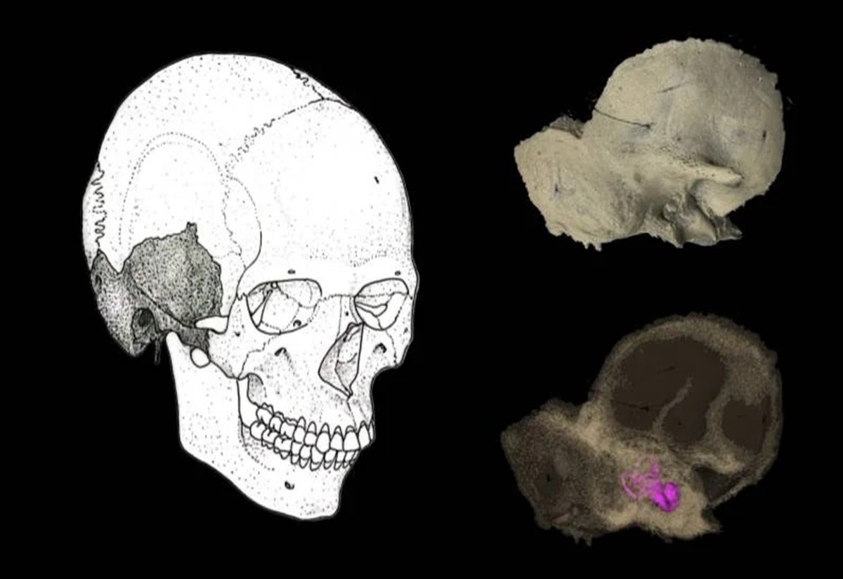 Links ist eine schwarz-weiße Linienzeichnung eines menschlichen Schädels zu sehen. Rechts befinden sich zwei dreidimensionale Darstellungen von Schädelteilen, die in unterschiedlichen Farben gehalten sind. Das obere Objekt zeigt eine helle, beige Oberfläche, das untere Objekt ist dunkler und enthält einen auffälligen, pinkfarbenen Bereich. Alle Elemente sind vor schwarzem Hintergrund angeordnet.