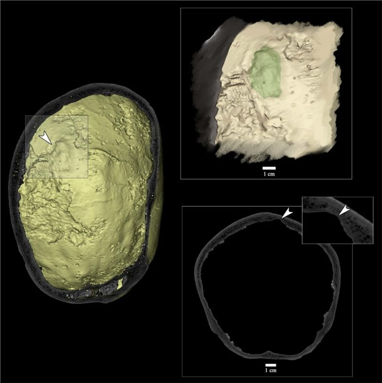 Schädeltumor  Virtuelles 3D-Modell und MicroCT-Bild des Schädels der Grube Marcenejas mit der Läsion, die dem Hirntumor entspricht. Foto: DEATHREVOL-Forschungsteam